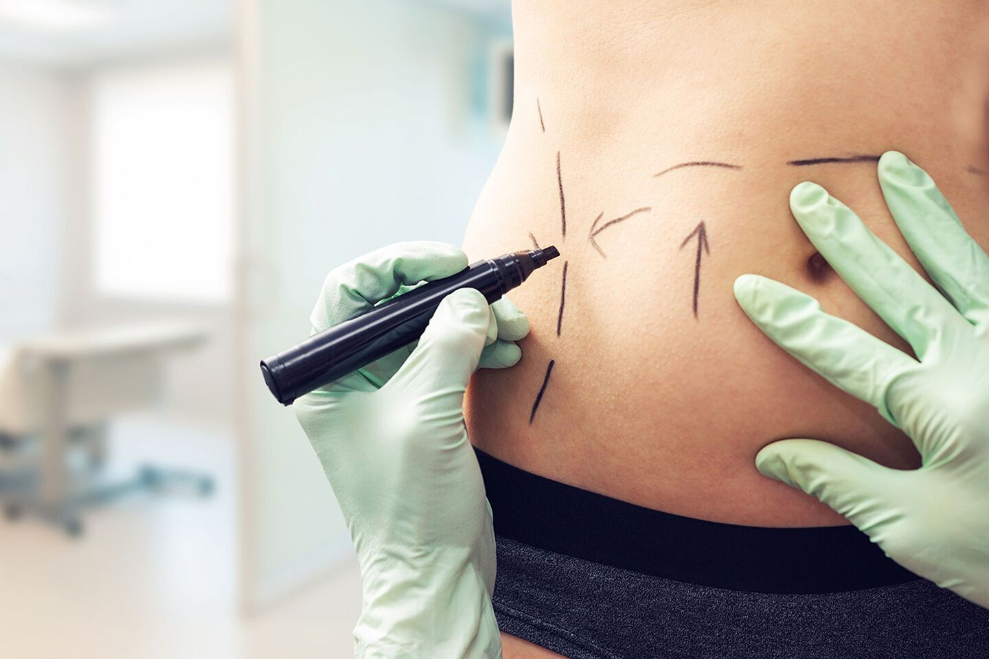 Liposuction procedure