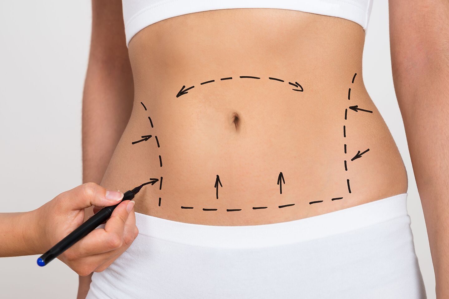 Tummy tuck procedure