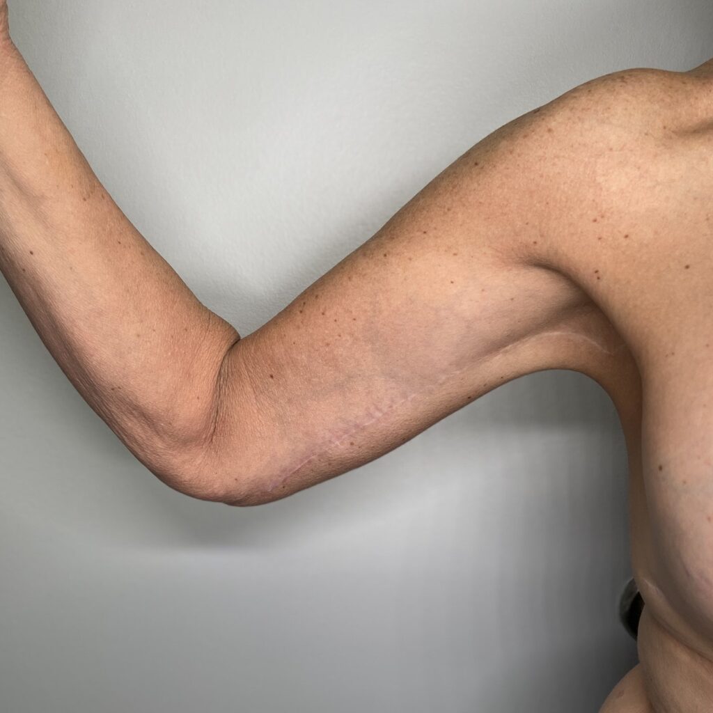 After – Front Right Arm View