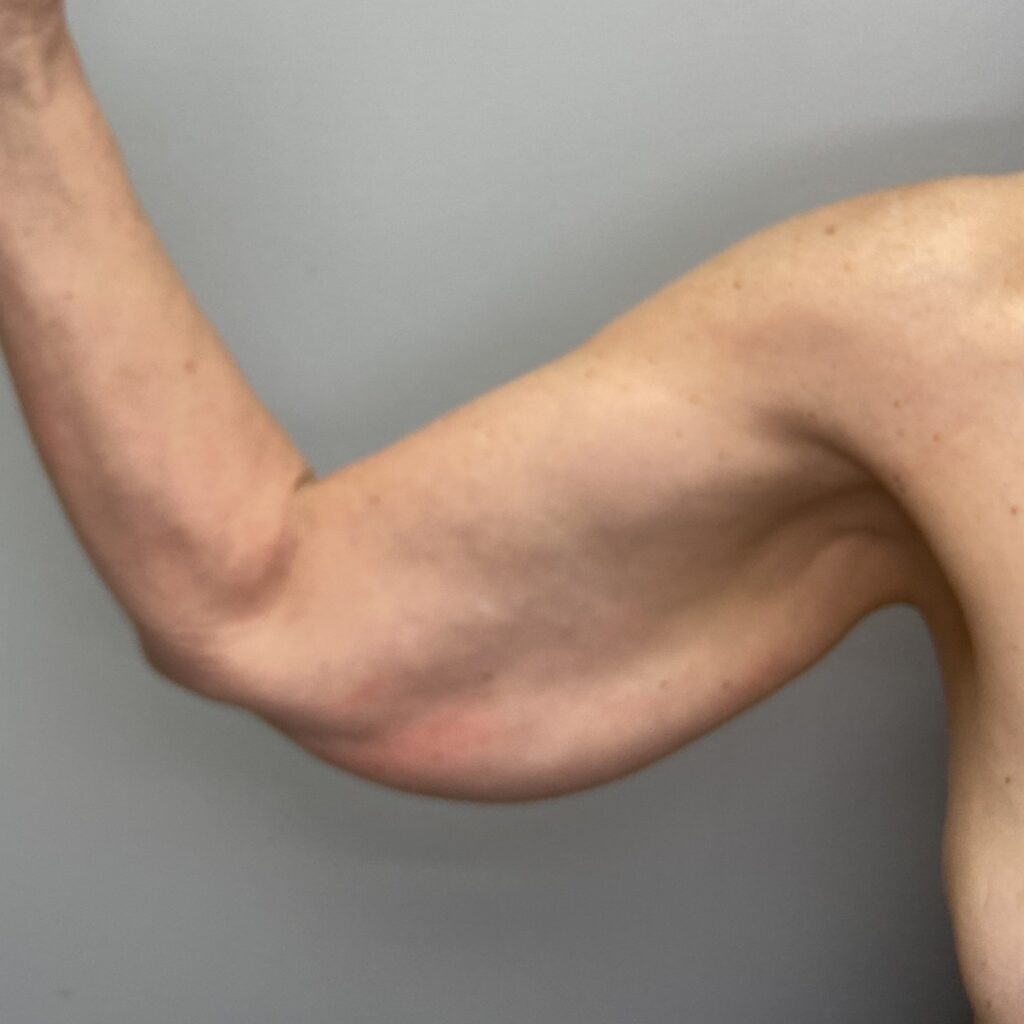 Before – Front Right Arm View