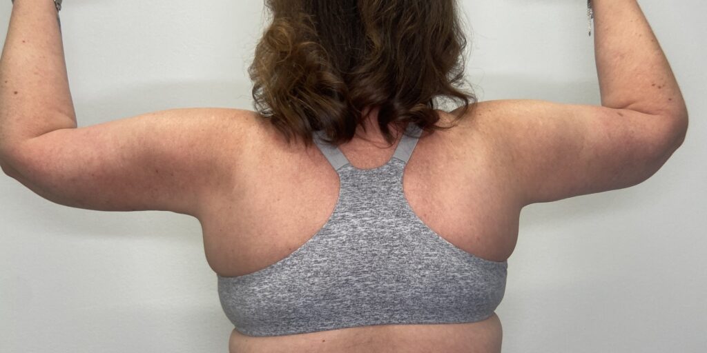 After – Back View