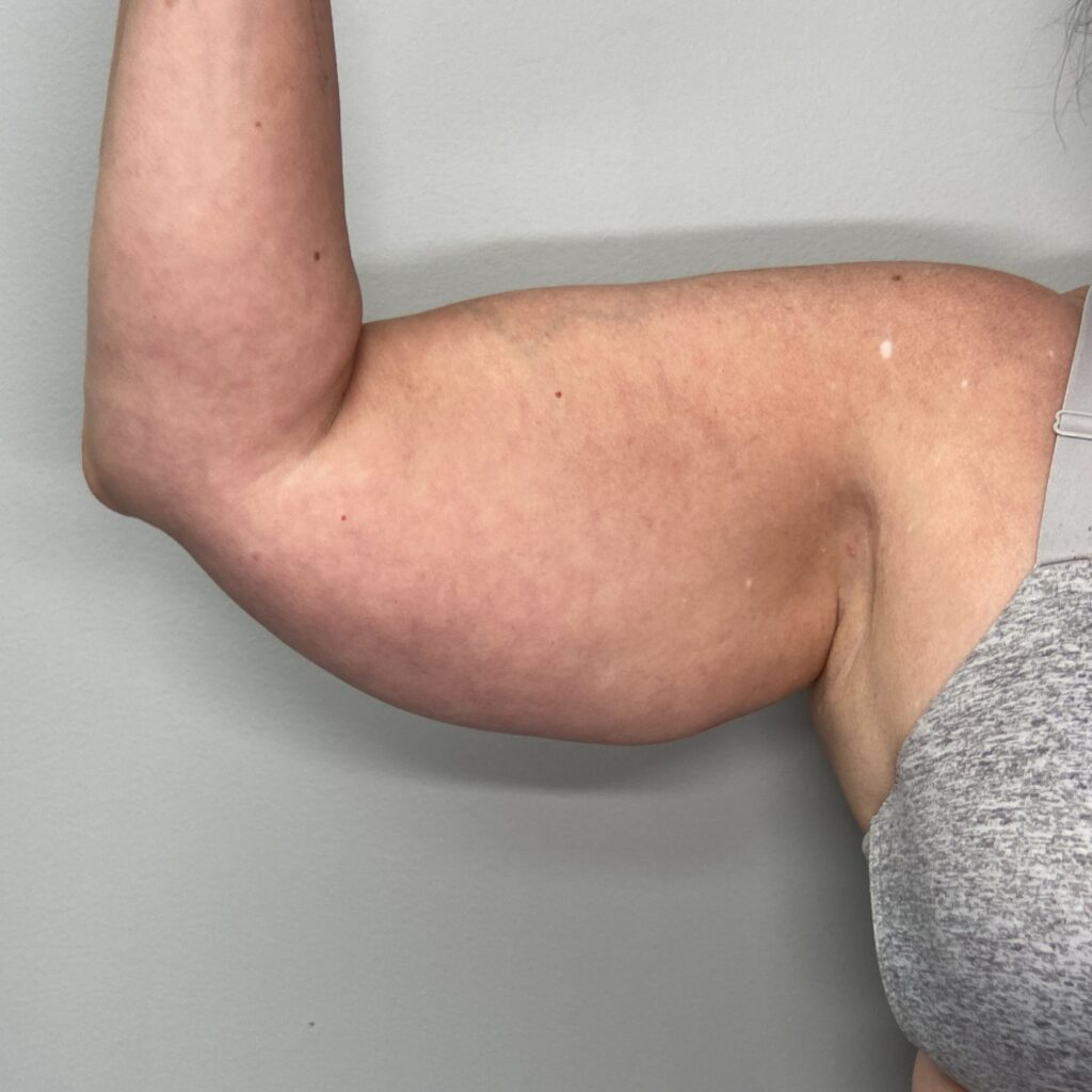 Before – Front Right Arm View