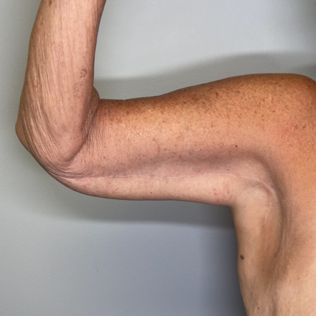 After – Front Right Arm View
