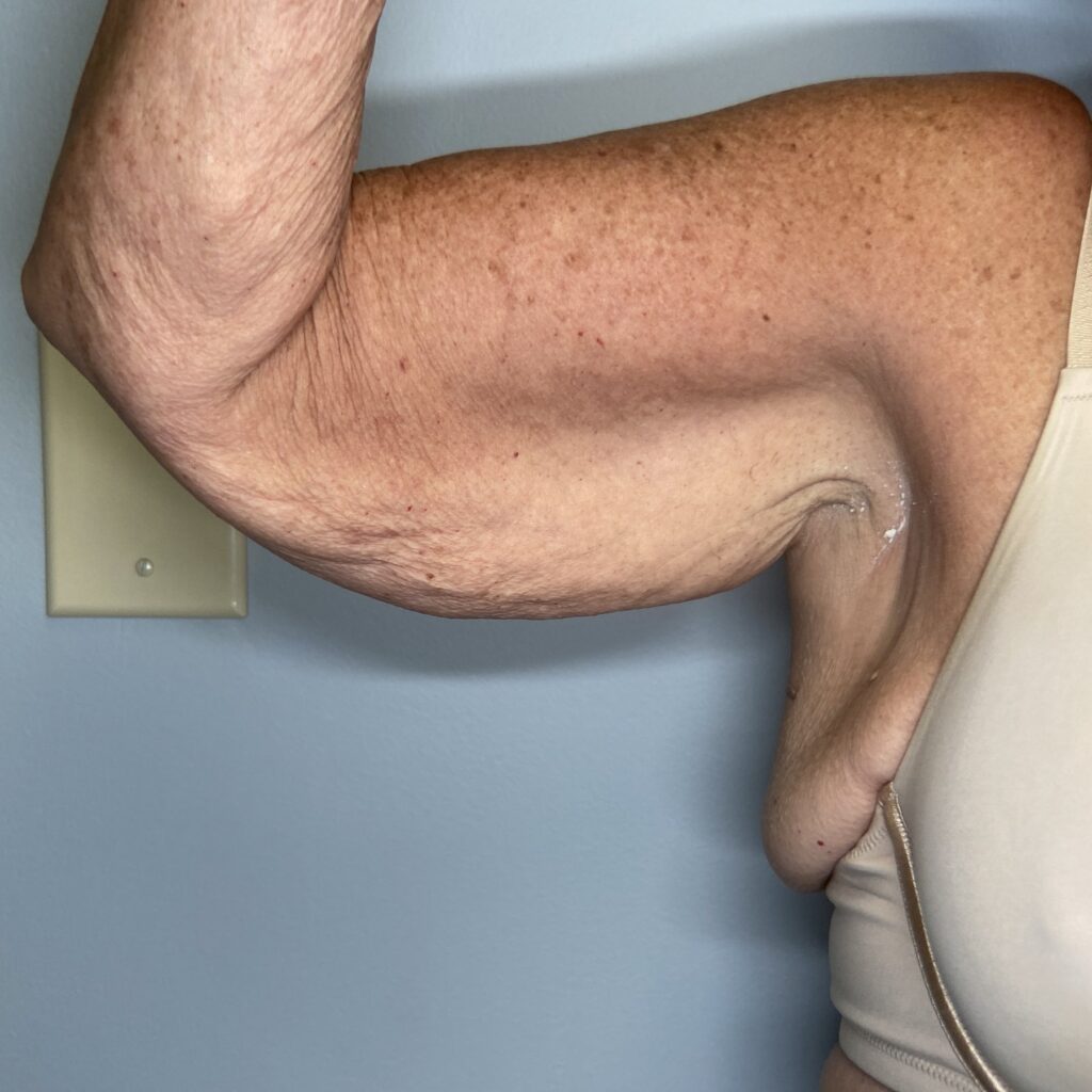 Before – Front Right Arm View