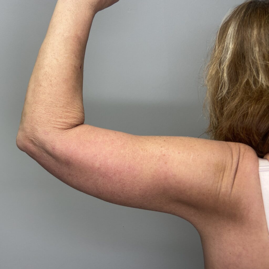 After – Back Left Arm View