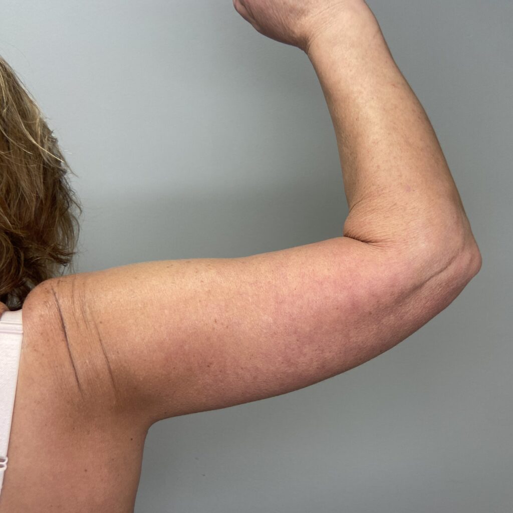 After – Back Right Arm View