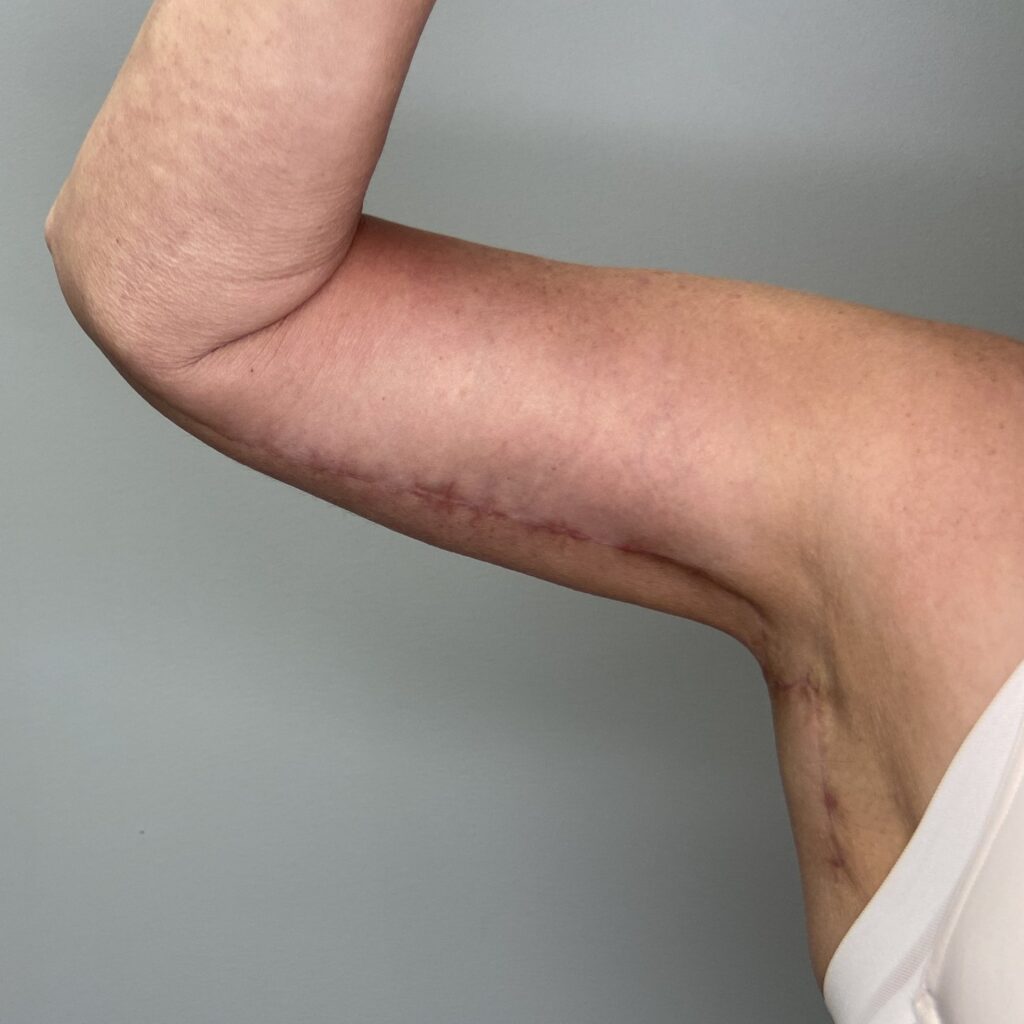 After – Front Right Arm View