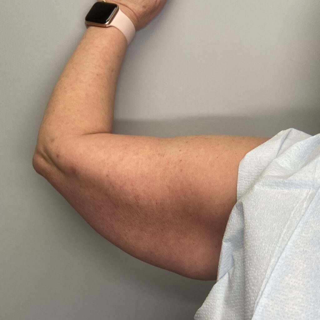 Before – Back Left Arm View