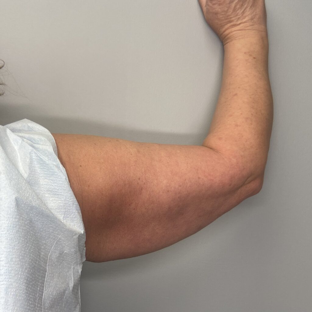 Before – Back Right Arm View