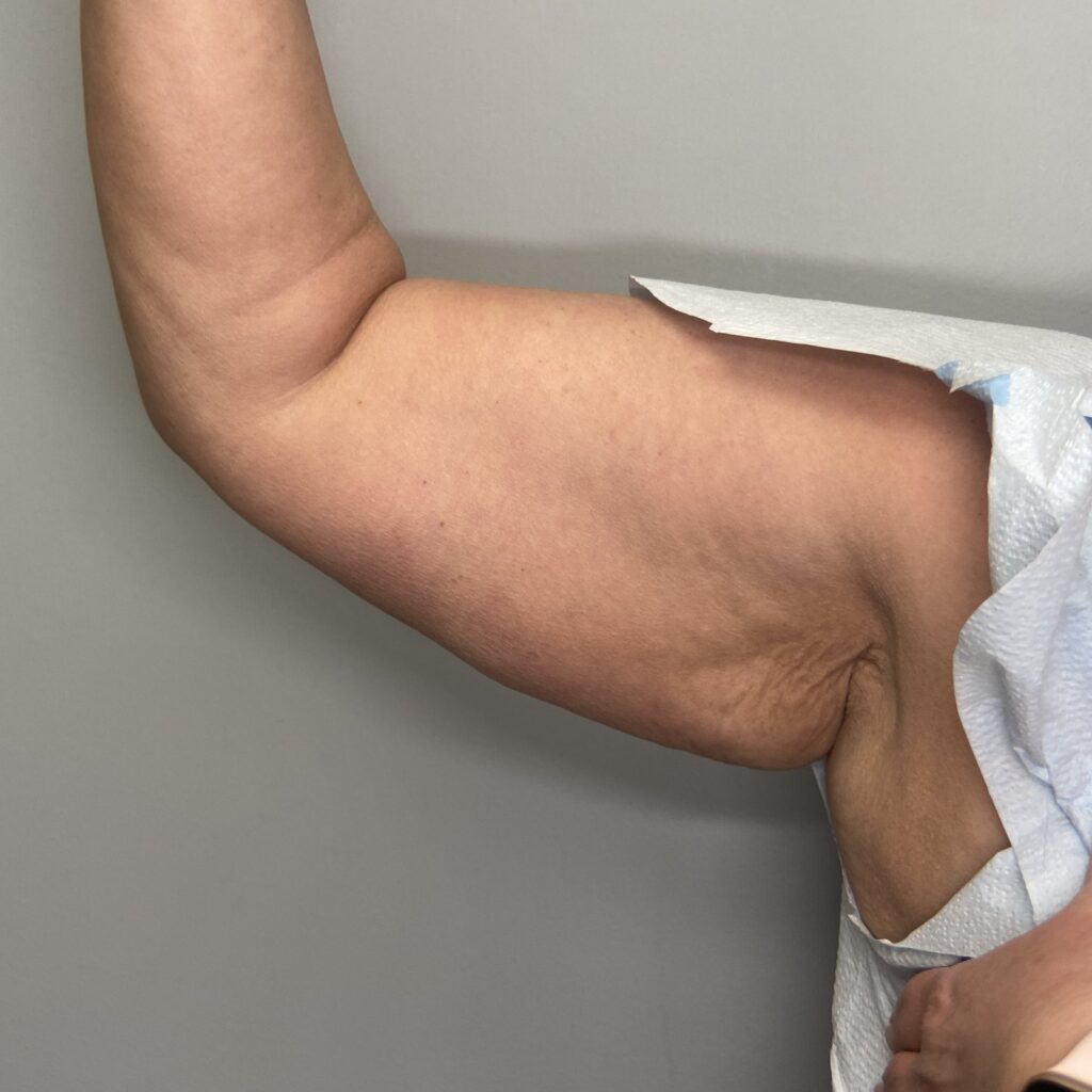 Before – Front Right Arm View
