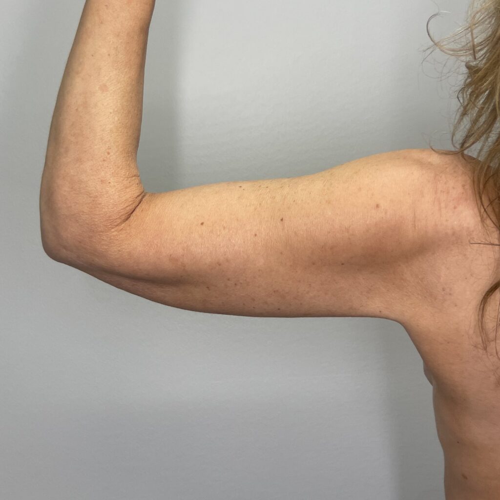 After – Back Left Arm View