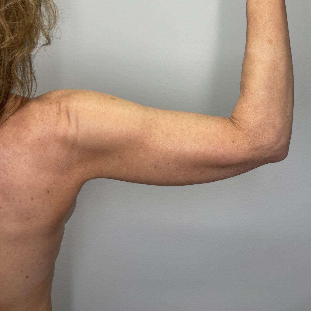 After – Back Right Arm View