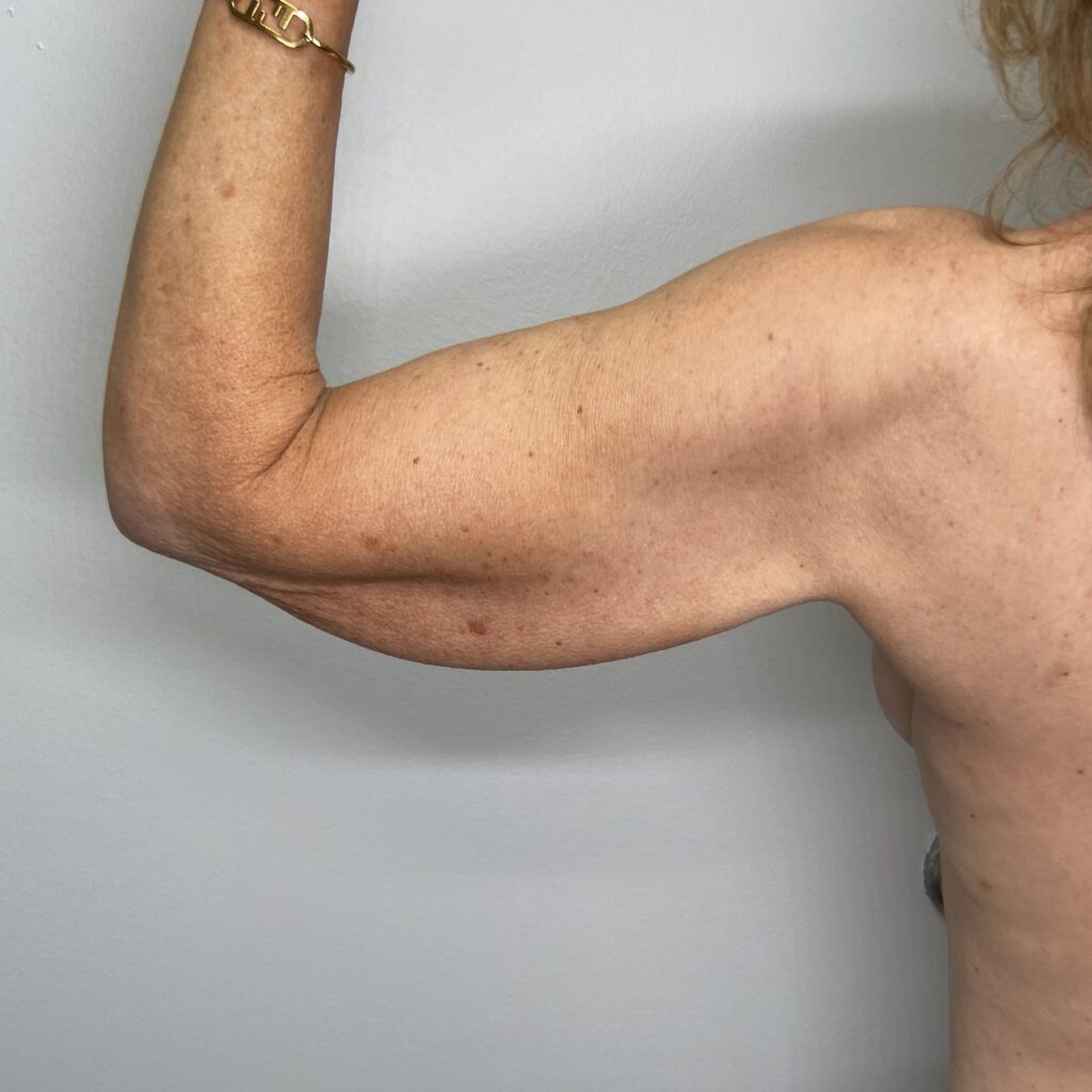 Before – Back Left Arm View