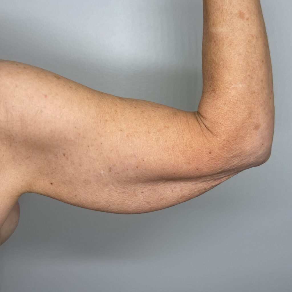 Before – Back Right Arm View