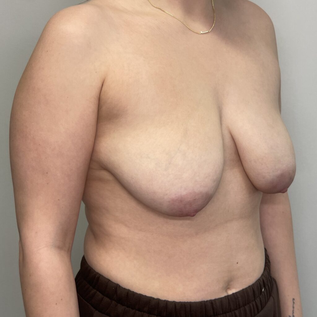 Before – Oblique View