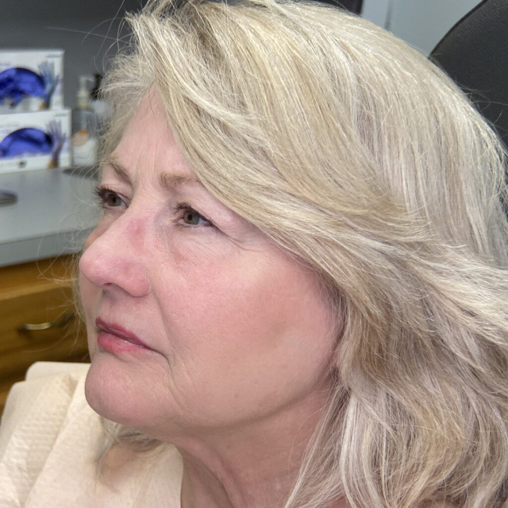 Before – Side View