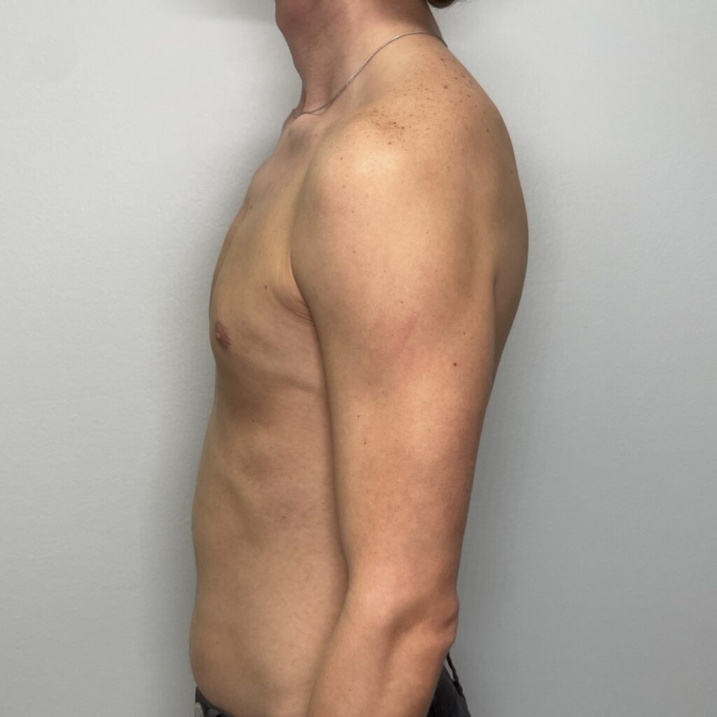 After – Side View