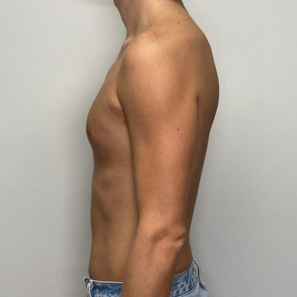 Before – Side View