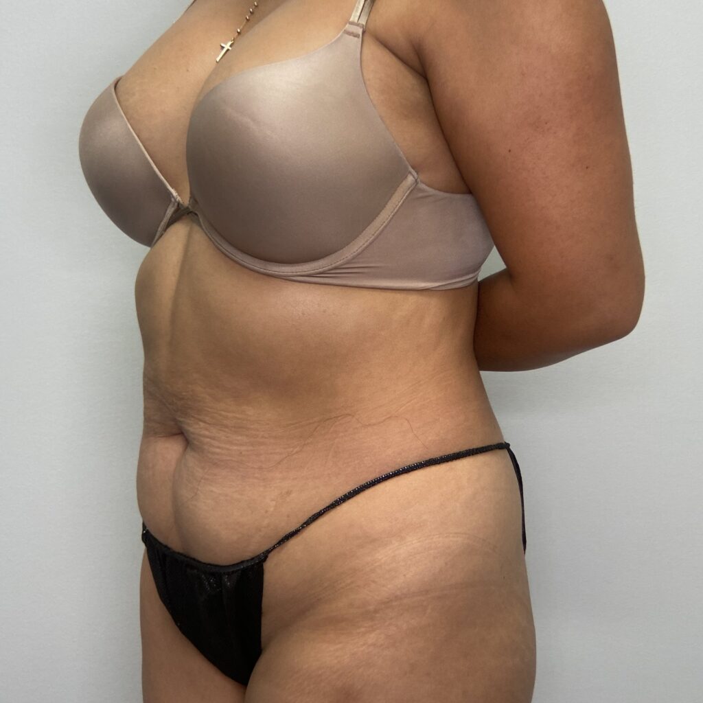 Before – Oblique View