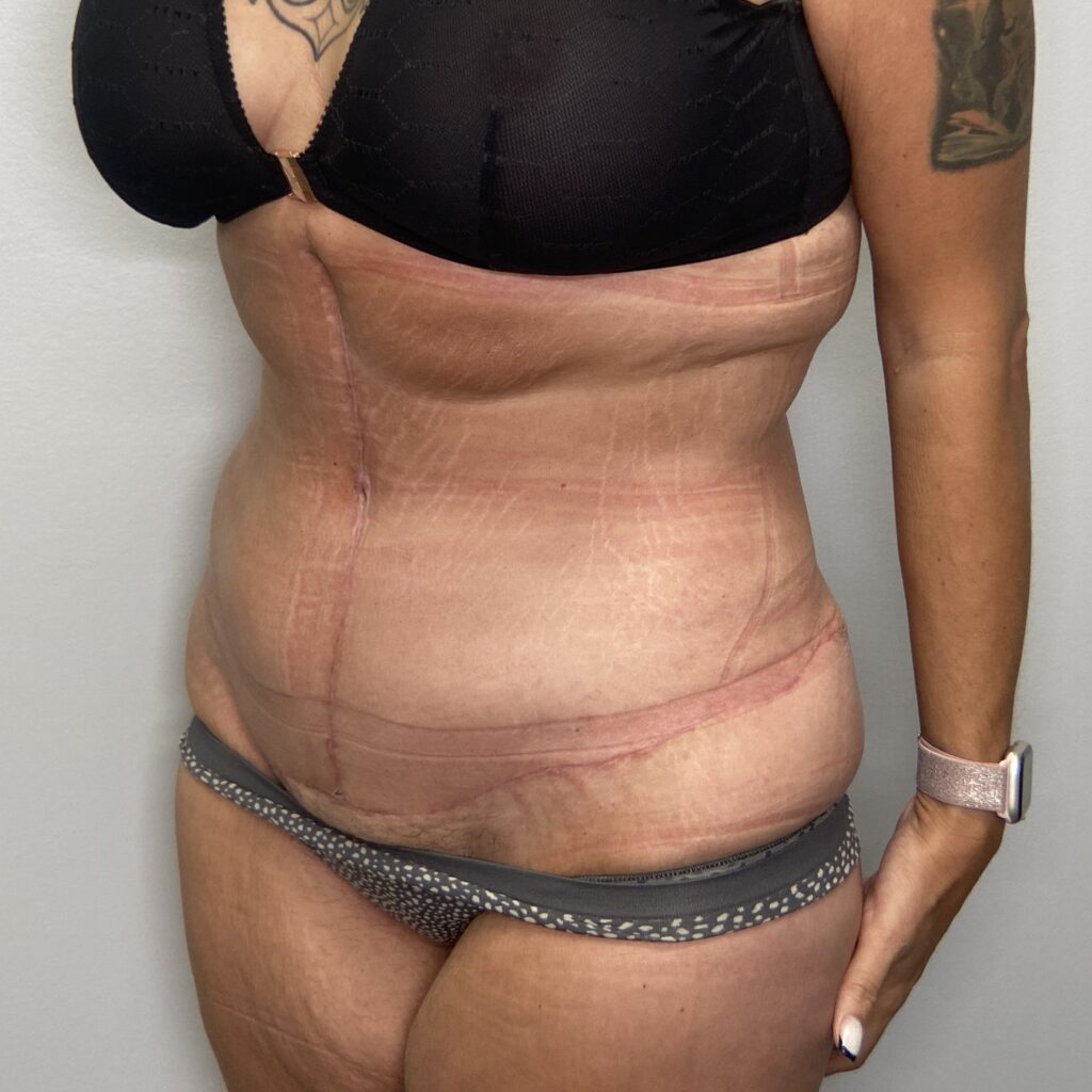 After – Oblique View