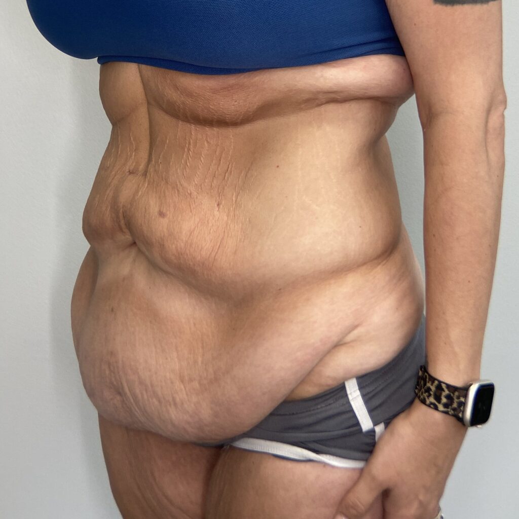 Before – Oblique View